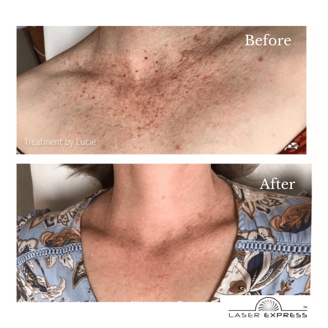 Froxle Fraxel Laser Brisbane & Gold Coast | Advanced Wrinkle Removal – Laser ...